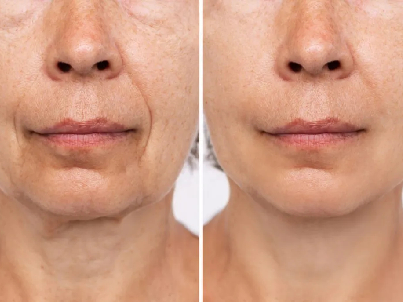 Marionette Lines Treatment